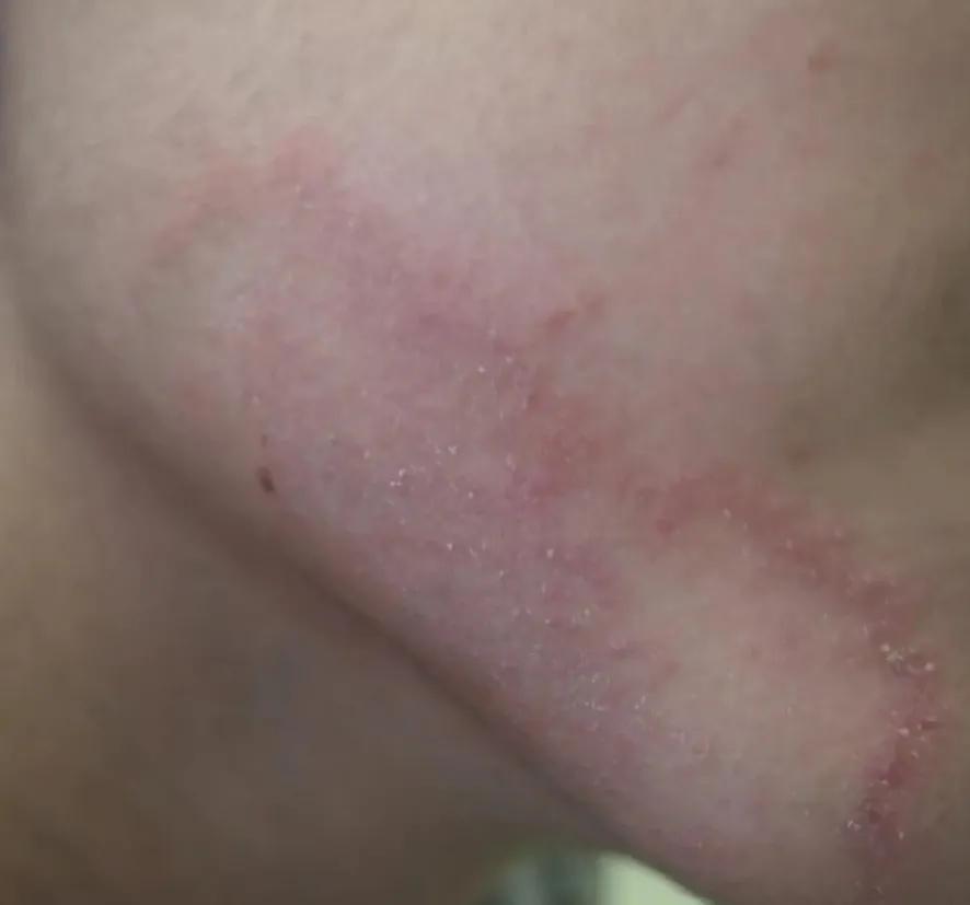 人身上的猫藓会传染给人吗