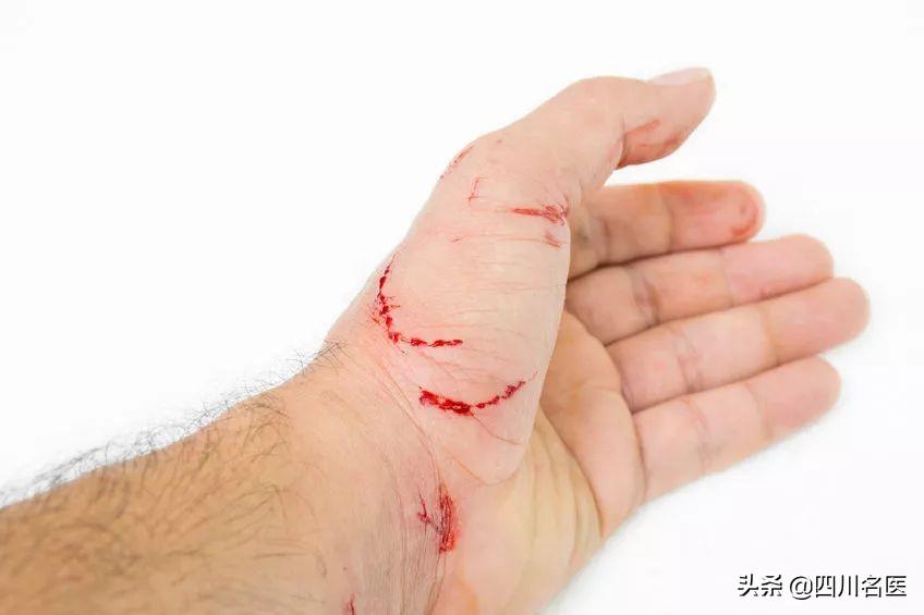 狂犬病潜伏期长达20年（狂犬病潜伏10年发病了）