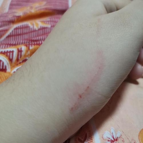 被猫抓了怎么判断没事