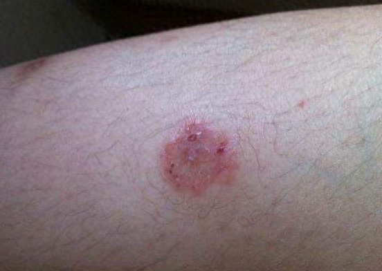 猫癣初期症状图有吗（附：猫藓难根治的原因及治疗与预防）